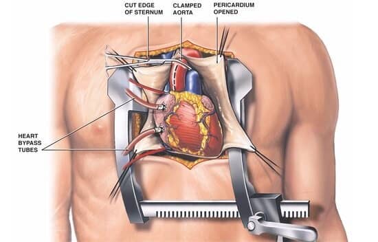 Open-Heart Surgery