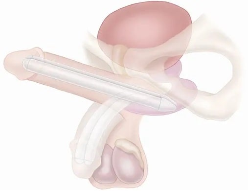 Penile Implant Surgery