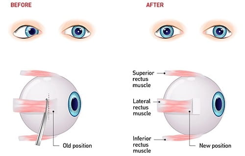Squint Eye Surgery