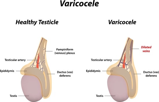 Varicocele Surgery Cost