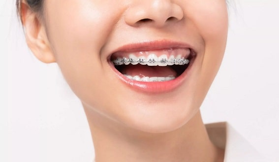 Teeth Braces Cost India