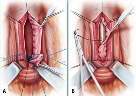 Urethroplasty Surgery